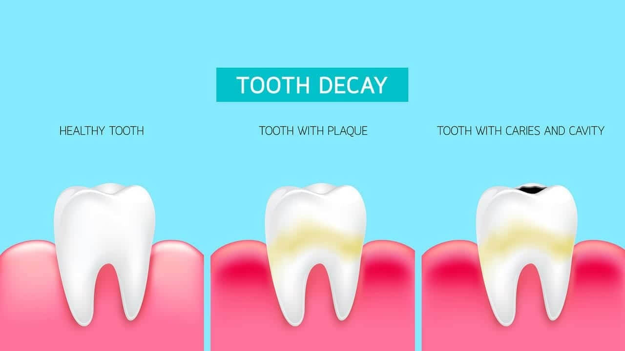 cavities